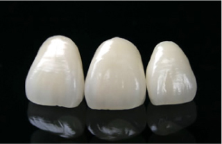 オールセラミックス(被せ物/詰め物)